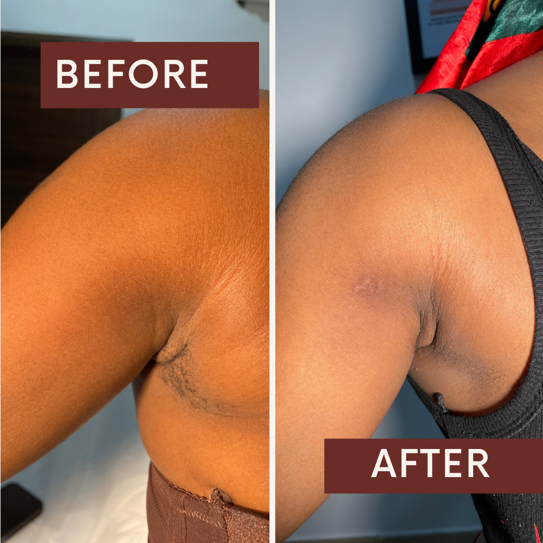 Laser Hair Removal Treatment Session at Fae Lifestyle