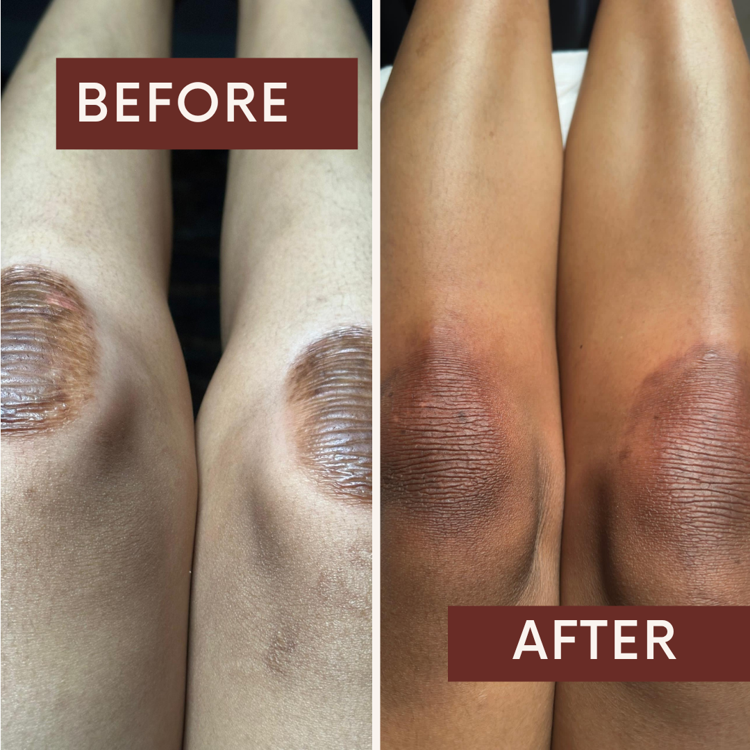 Laser Hair Removal Treatment Session at Fae Lifestyle