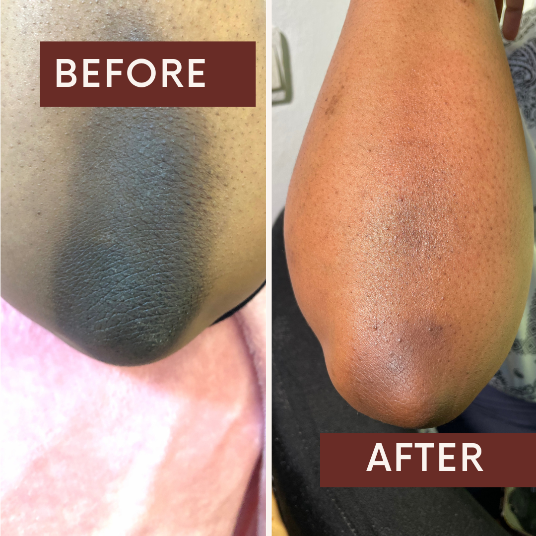 Precise Laser Hair Removal Skincare Session at Fae Lifestyle