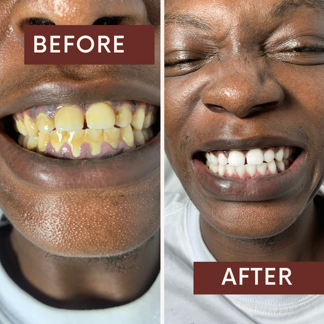 Enamel-Safe Whitening Treatment at Fae Lifestyle
