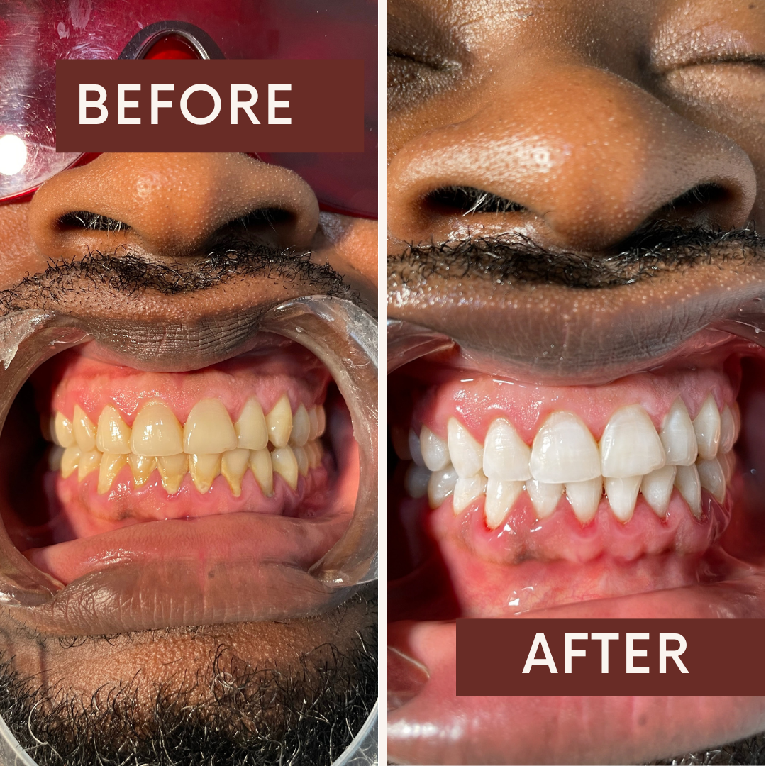 Bright Confident Smile After Teeth Whitening at Fae Lifestyle